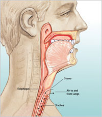 Laryngectomy - ASLTIP